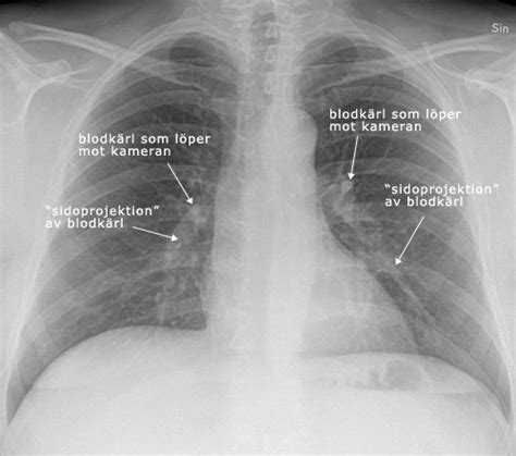 lungröntgen frisk lunga